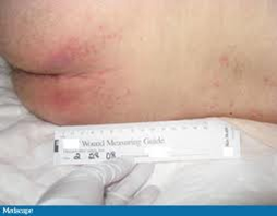 Stage 1 pressure ulcer, pale complexion.